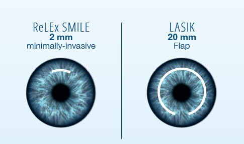 ReLEx Smile